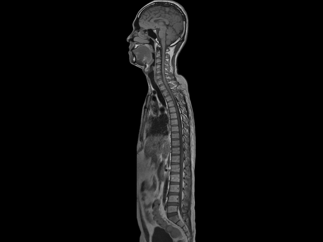 МРТ спины – что показывает?