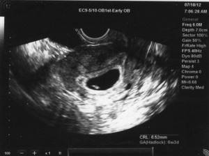 УЗИ на 4 неделе беременности: нормы, фото