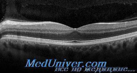 Оптическая когерентная томография глаза и сетчатки