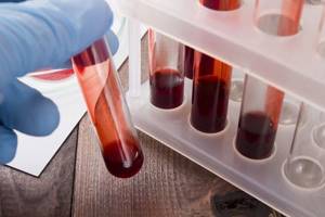 Причины пойкилоцитоза в общем анализе крови