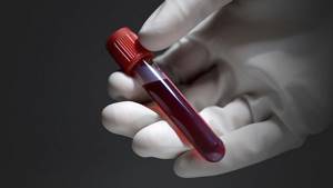 АЧТВ в анализе крови – что это: расшифровка, норма