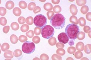 Повышены лейкоциты в крови у женщин: причины, симптомы, лечение