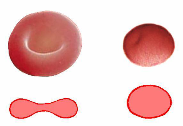 Причины пойкилоцитоза в общем анализе крови