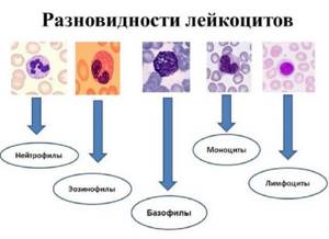Лейкоциты в крови повышены: что это значит, причины, что делать?